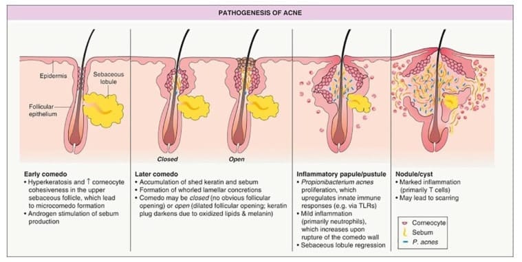 Challenge of comedonal acne treatment grounded in 4 essential ...